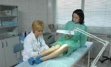 kako liječiti proširene vene na nogama