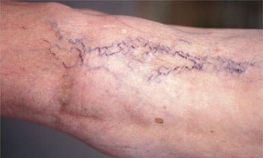 metode liječenja proširenih vena na nogama