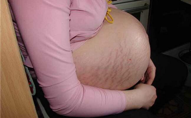 uzroci proširenih vena tijekom trudnoće