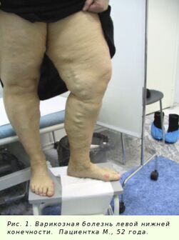 Proširene vene moraju se liječiti kako bi se proces zaustavio