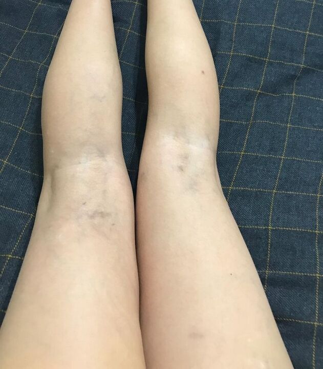 manifestacije proširenih vena na nogama