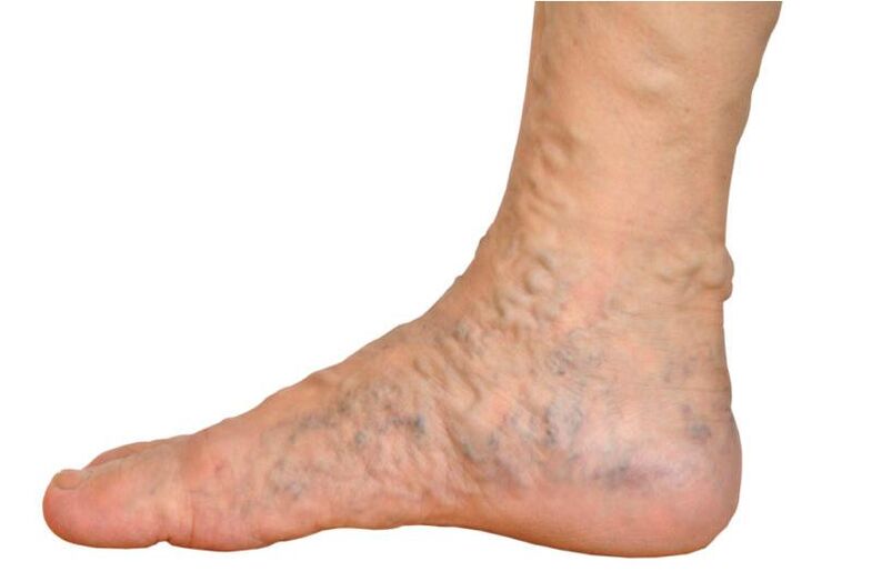 Proširene vene na nozi