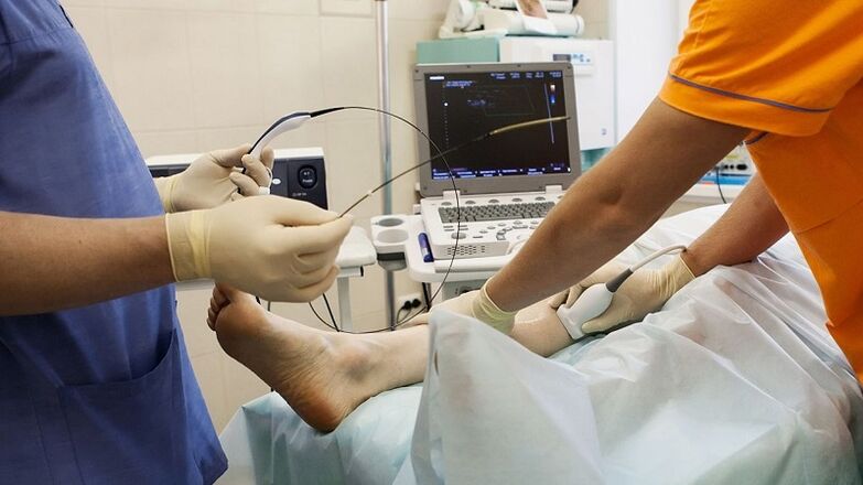 operacija za uklanjanje proširenih vena